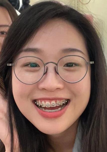 正畸自锁要换几次钢丝-图1