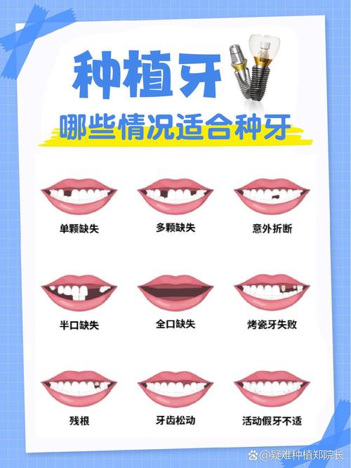 种植牙上最多能种几颗？单颗种植体能支撑多颗牙吗？-图1