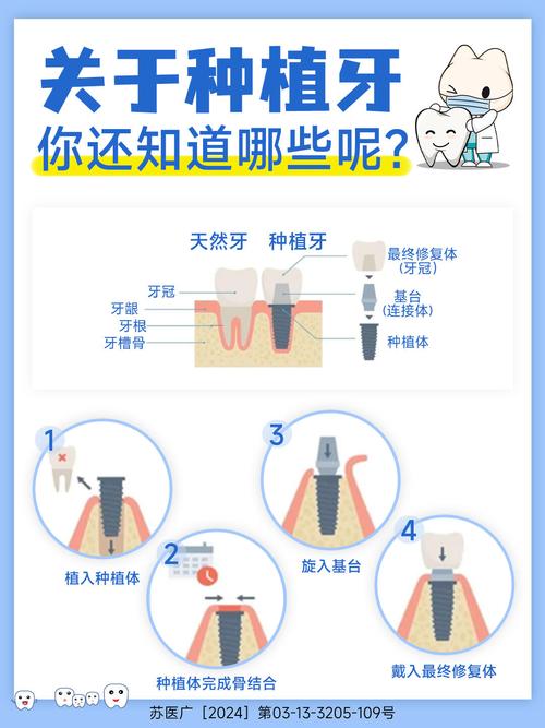 种植牙上最多能种几颗？单颗种植体能支撑多颗牙吗？-图2