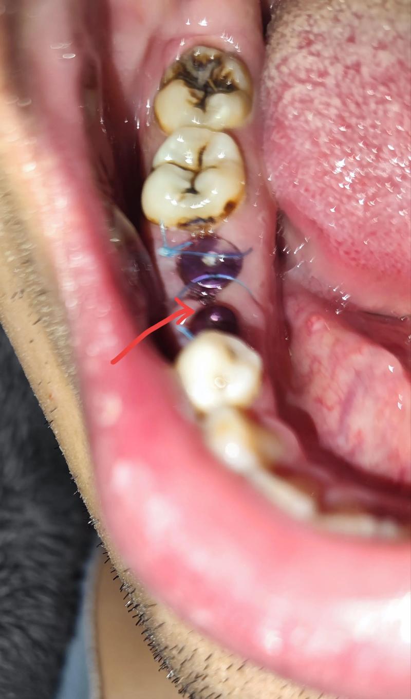 种植牙种牙根后怀孕-图1