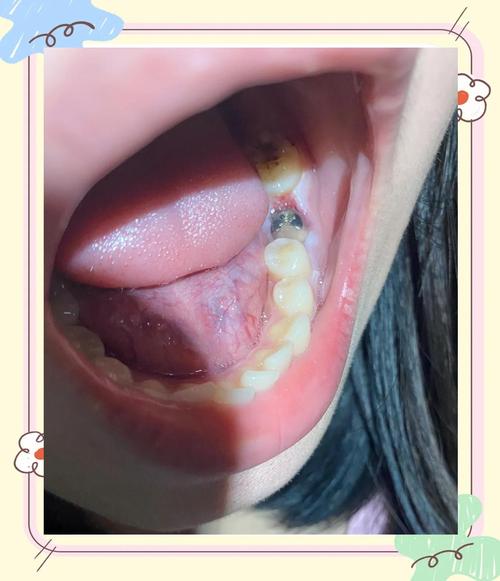 种牙失败具体有哪几种常见情况呢？-图1