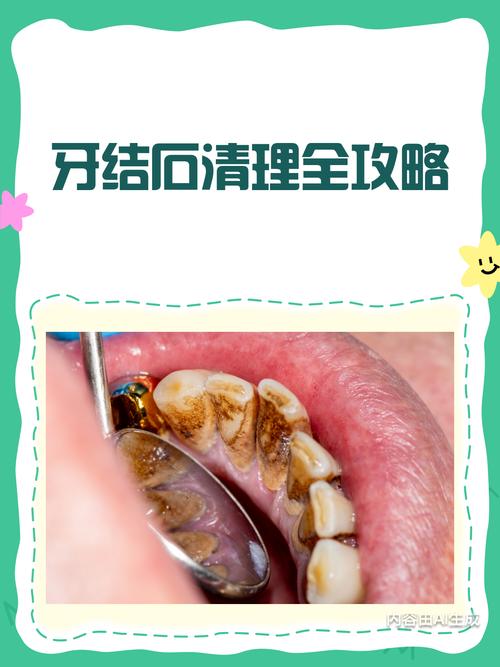 清牙结石最好方法是什么？如何找到最有效且不伤牙的清洁方式？-图2