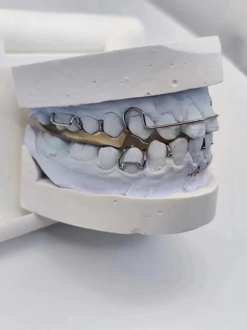 地包天牙用什么方法矫正比较好?-图1 地包天牙用什么方法矫正比较好?-图1