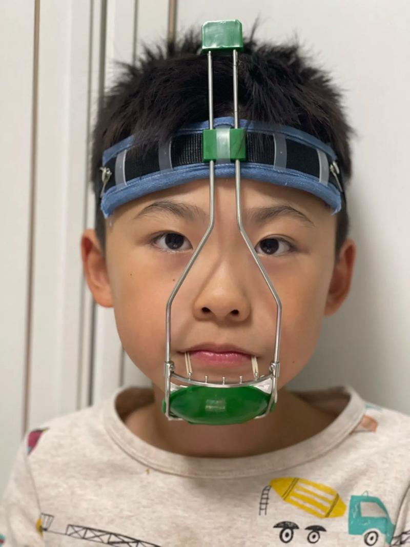 地包天牙用什么方法矫正比较好?-图3 地包天牙用什么方法矫正比较好?-图3