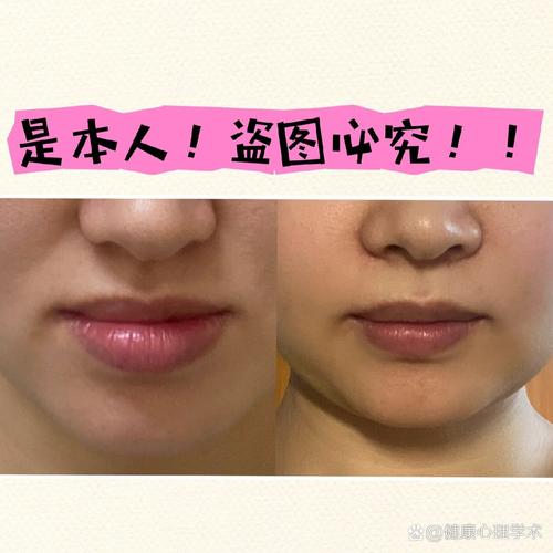 南京口腔整形有哪些方法？如何选择适合自己的？-图2