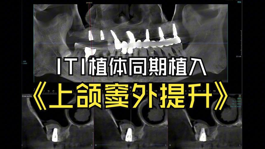 什么是种牙外提升手术？视频详解关键操作步骤-图1