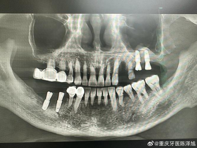 什么是种牙外提升手术？视频详解关键操作步骤-图2