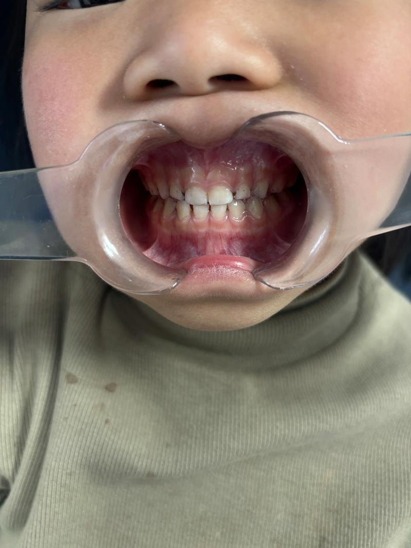 乳牙反颌矫治方法有哪些具体类型和适用选择？-图1