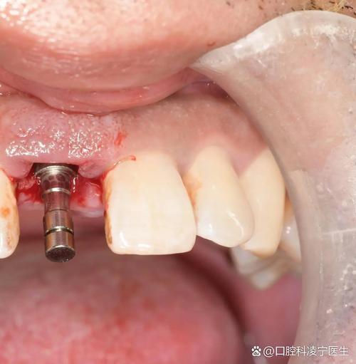 当天种牙当天啃骨头？真有这么快？-图2