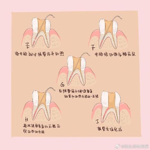 牙体充填术补牙方法-图3 牙体充填术补牙方法-图3