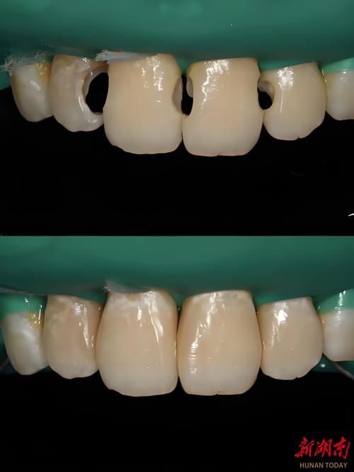 树脂种牙是否需要磨牙？-图2