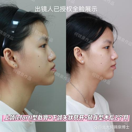 偏颌需先手术后正畸？顺序是否科学？效果如何？-图3