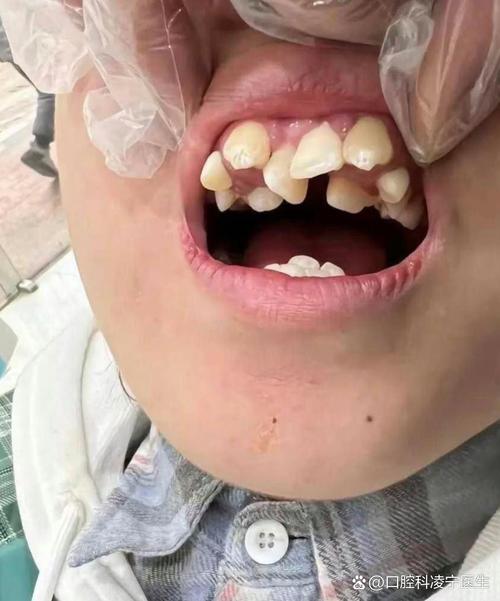 偏颌需先手术后正畸？顺序是否科学？效果如何？-图2