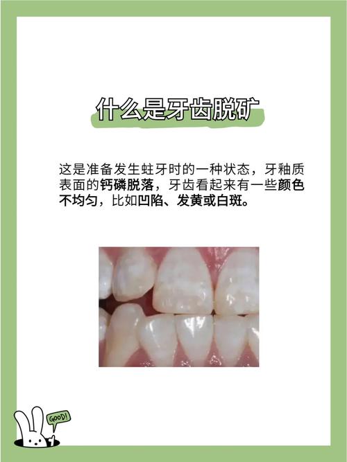 牙齿矿化的治疗方法有哪些？如何有效选择？-图2