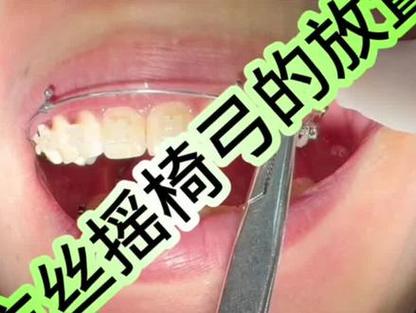 正畸摇椅弓临床应用中，选择哪种弓丝效果最佳？材质与尺寸怎么选？-图2