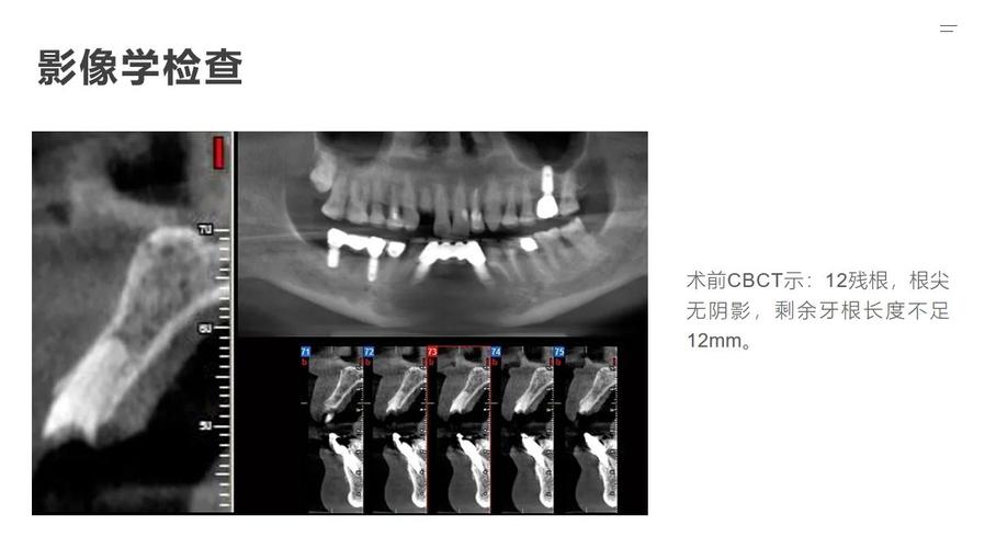 种牙外提升手术感受如何？真实体验与术后恢复过程怎样？-图1