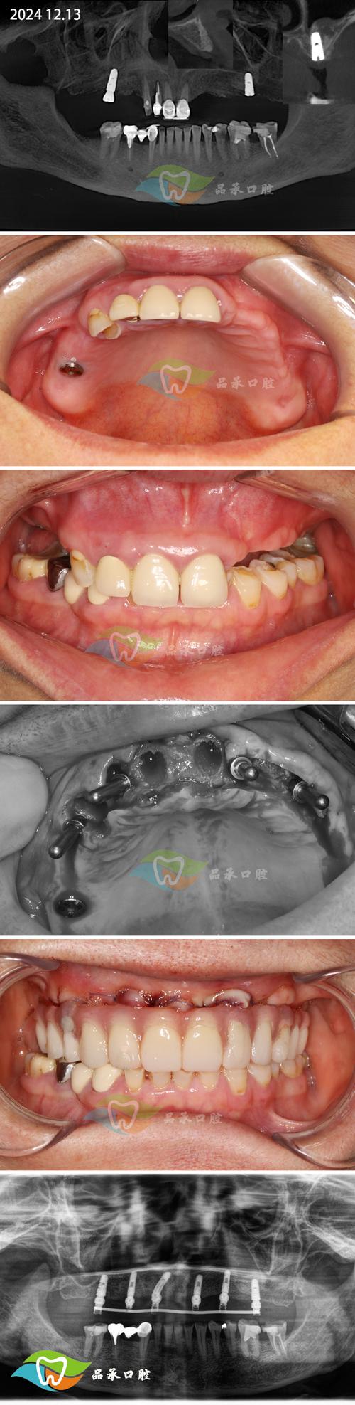 种牙外提升手术感受如何？真实体验与术后恢复过程怎样？-图2