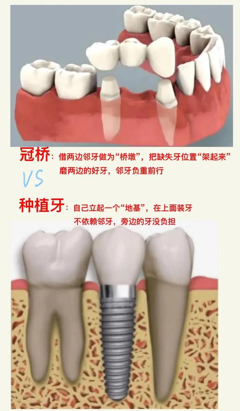 做过瓷牙后还能种牙吗？有影响吗？-图2