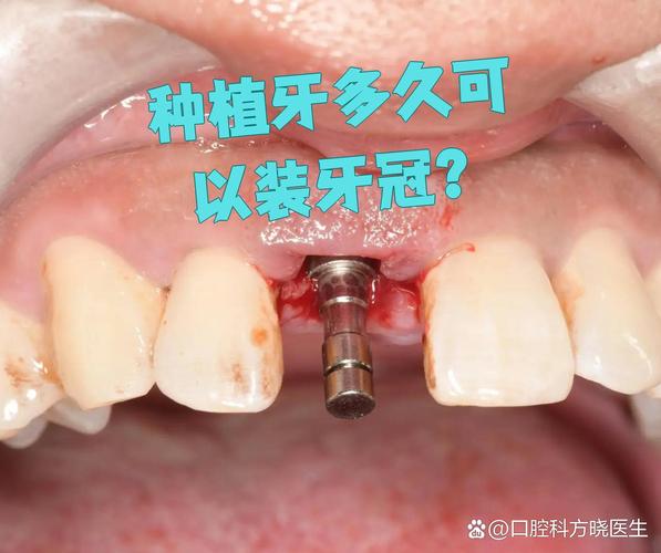 种牙后多久能装牙冠？时间节点是关键？-图2