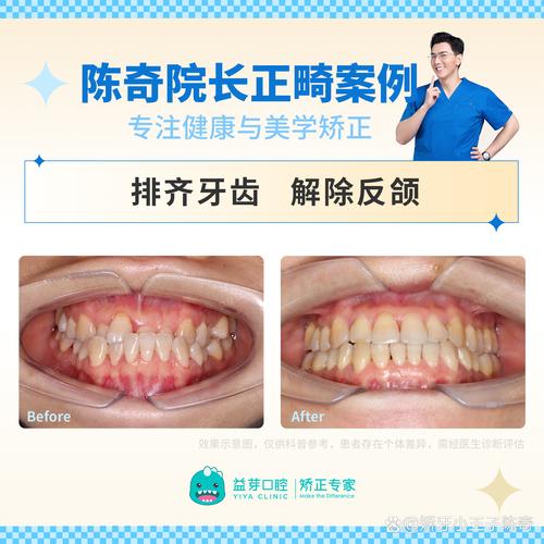 关节好了就可以正畸吗？-图3