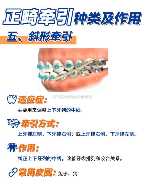 正畸三类牵引皮筋型号有哪些?各自适用于哪些牙齿矫正情况?-图3 正畸三类牵引皮筋型号有哪些?各自适用于哪些牙齿矫正情况?-图3