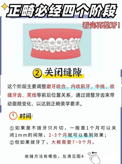 何为正畸替牙间隙？名词解释的核心内容是什么？-图1