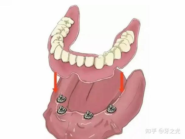 拔牙种牙要花多少钱？价格差异大吗？-图3