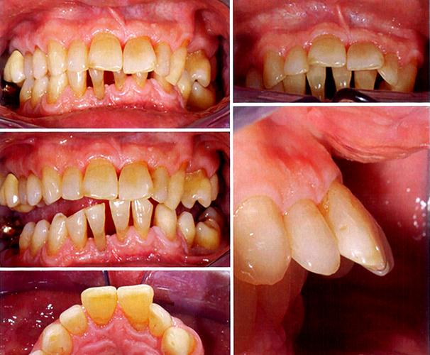 正畸期间能治疗牙周吗-图1