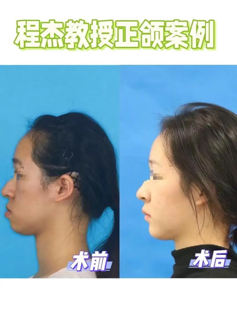 浙江省内反颌正畸专家去哪找？治疗效果好不好？靠谱吗？-图2