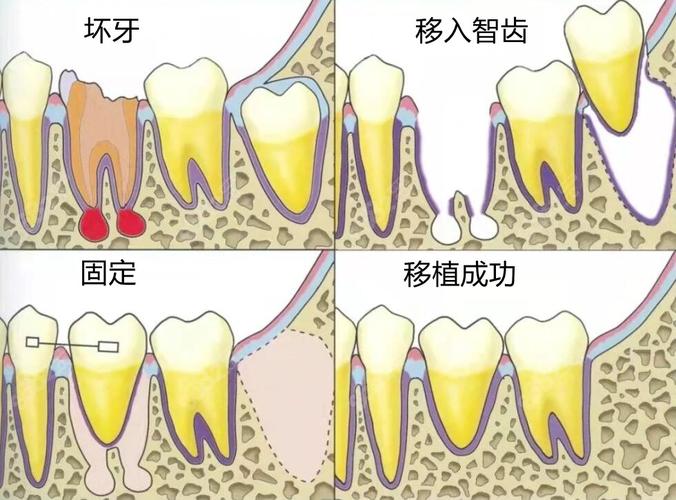 自体牙移植手术方法的具体步骤和要点是什么？-图1