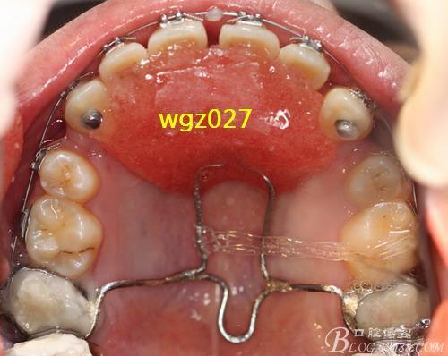 正畸平面导板治疗前后的对照图能看出哪些具体矫正效果？-图2