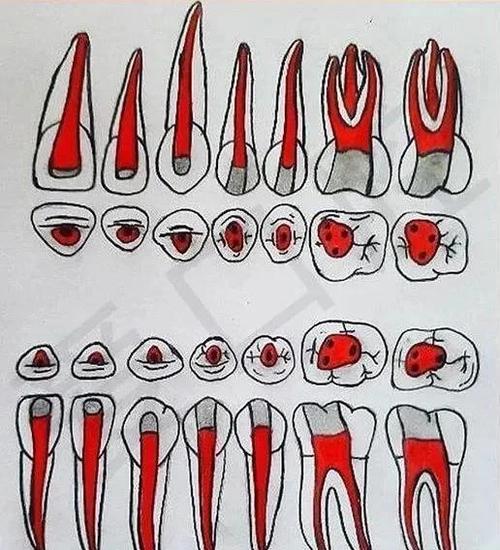 口腔下颌7开髓方法的标准操作流程及操作技巧有哪些?-图2 口腔下颌7开髓方法的标准操作流程及操作技巧有哪些?-图2