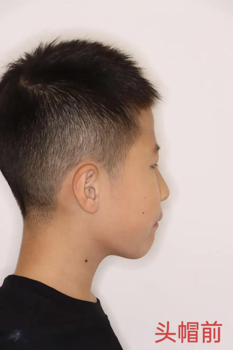 头帽正畸晚上佩戴可行吗？时长和注意事项有哪些？-图2