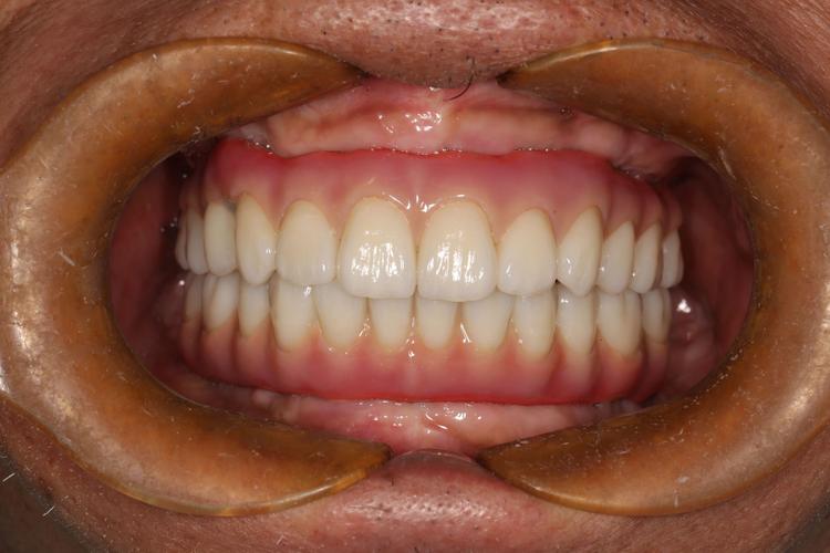 种植牙种出来像龅牙，是种植体位置问题还是医生操作失误？-图2