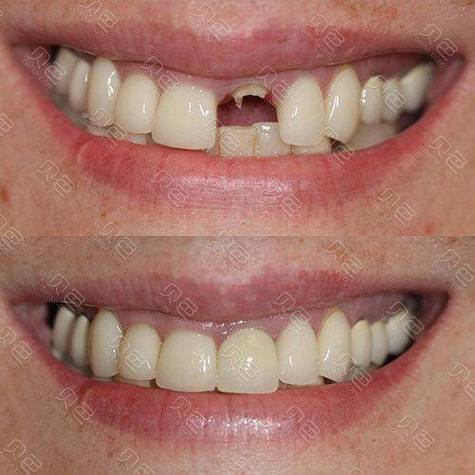 种植牙种出来像龅牙,是种植体位置问题还是医生操作失误?-图1 种植牙种出来像龅牙,是种植体位置问题还是医生操作失误?-图1