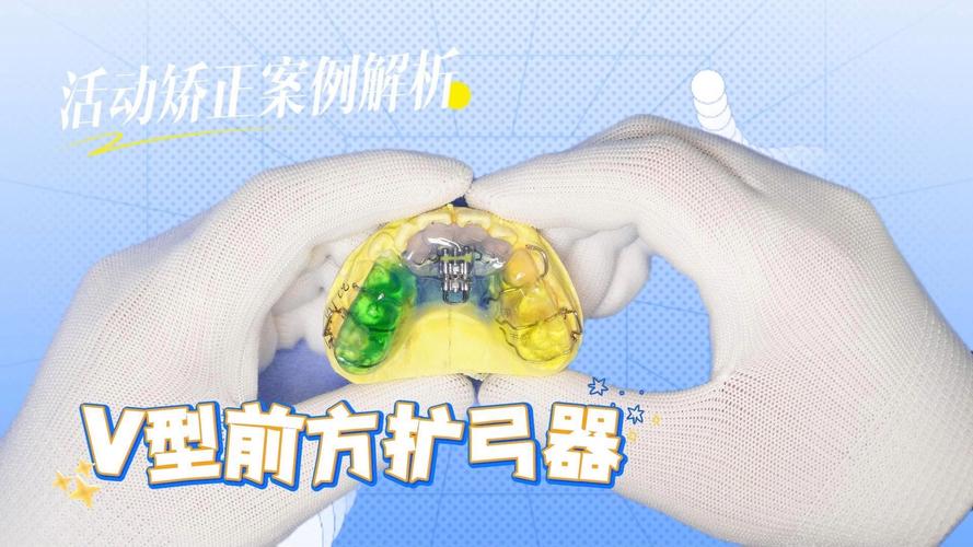 正畸快速扩弓器的简称是什么？-图3