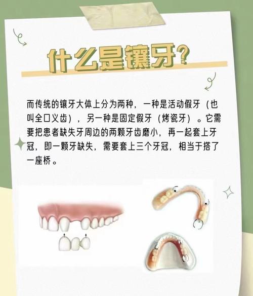 美国缺牙修复，种牙和镶牙哪个更合适？-图1