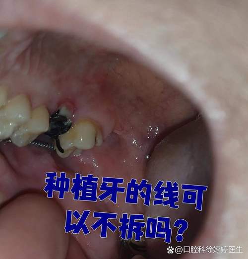 种牙拆线后几天能喝酒？-图3