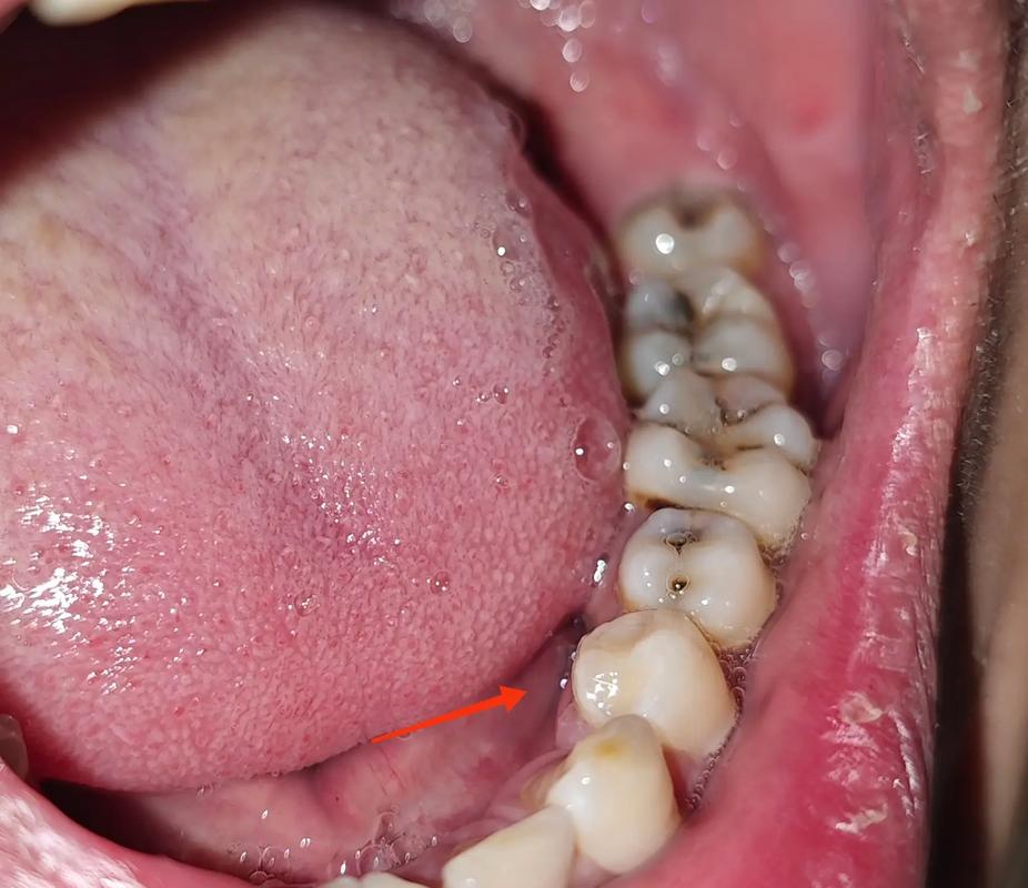 种牙拆线后几天能喝酒？-图2