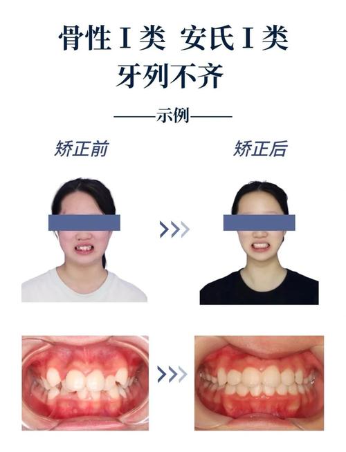 矫正牙齿拥挤的有效方法有哪些？不同情况如何推荐合适的矫正方式？-图3
