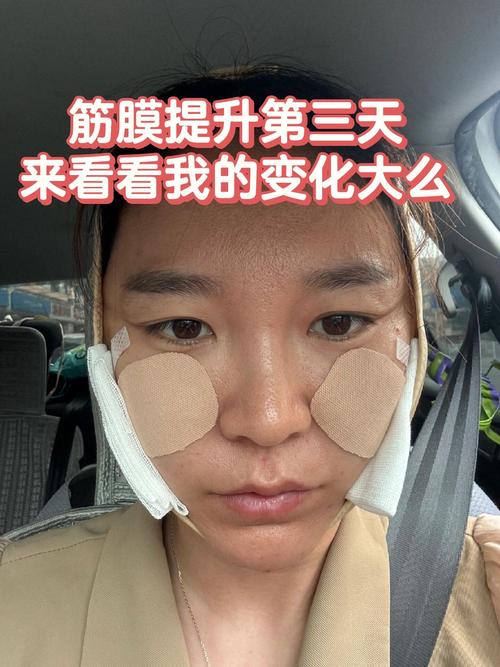 额窦粘膜恢复的有效方法有哪些？-图3