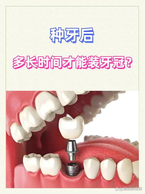 种牙的钉子能用多久?使用寿命受哪些因素影响?-图1 种牙的钉子能用多久?使用寿命受哪些因素影响?-图1