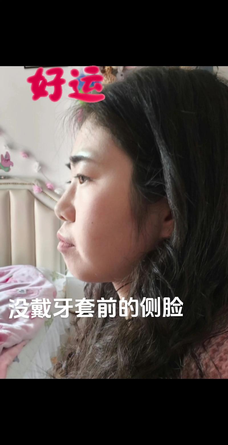 正畸上牙套后多久适应-图3 正畸上牙套后多久适应-图3