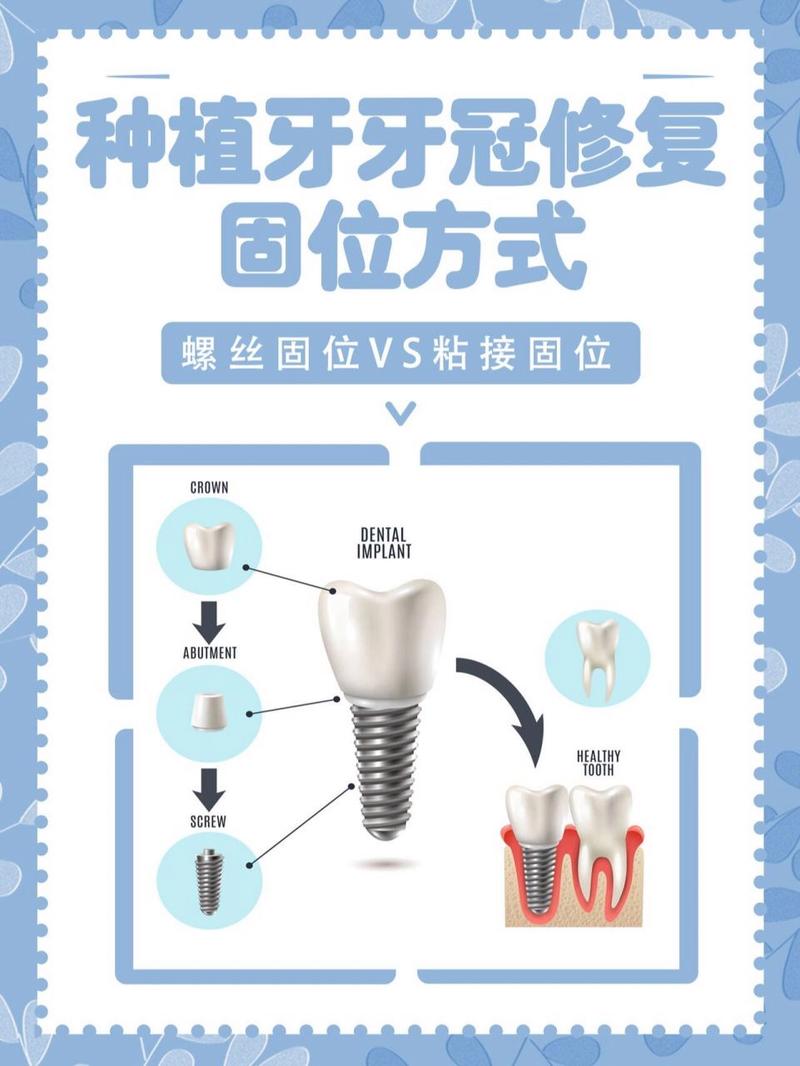 种牙装牙冠步骤图片能清晰展示每一步吗？-图3