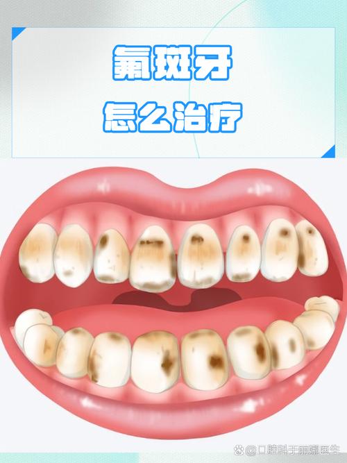 氟斑牙早期有哪些有效的治疗方法？-图1