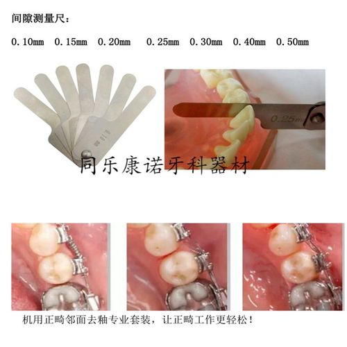 邻面去釉套装，正畸中为何要用？如何操作？-图2