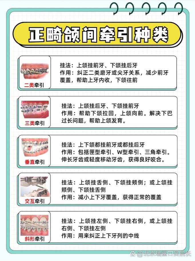 正畸里牵引是什么原因-图2 正畸里牵引是什么原因-图2