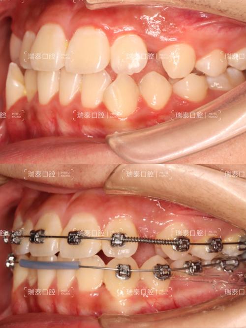 正畸牙齿一咬合就疼，是矫正反应还是需要处理的原因？-图2