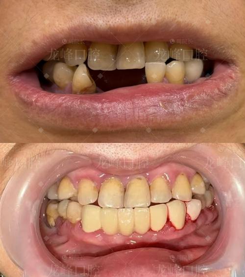 烤瓷连冠可以做正畸治疗吗？-图3