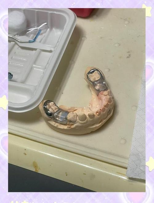 小孩正畸保持器有哪几种类型?如何正确选择和使用?-图2 小孩正畸保持器有哪几种类型?如何正确选择和使用?-图2